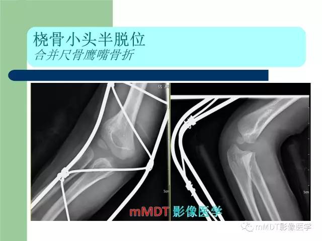 【PPT】儿童肘关节骨折的X线诊断
