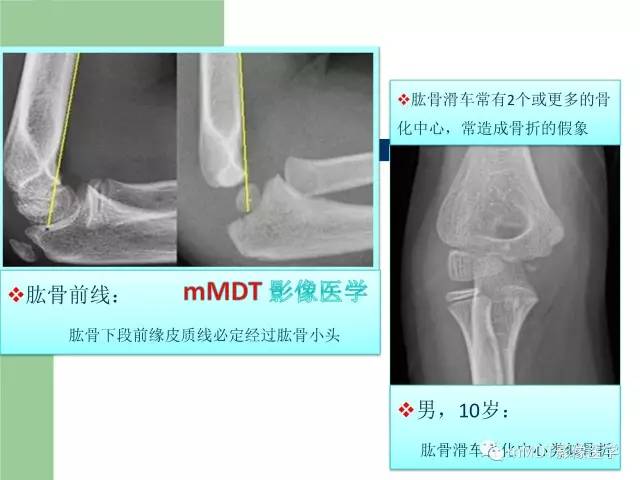 【PPT】儿童肘关节骨折的X线诊断