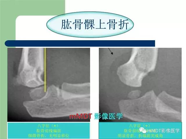 【PPT】儿童肘关节骨折的X线诊断