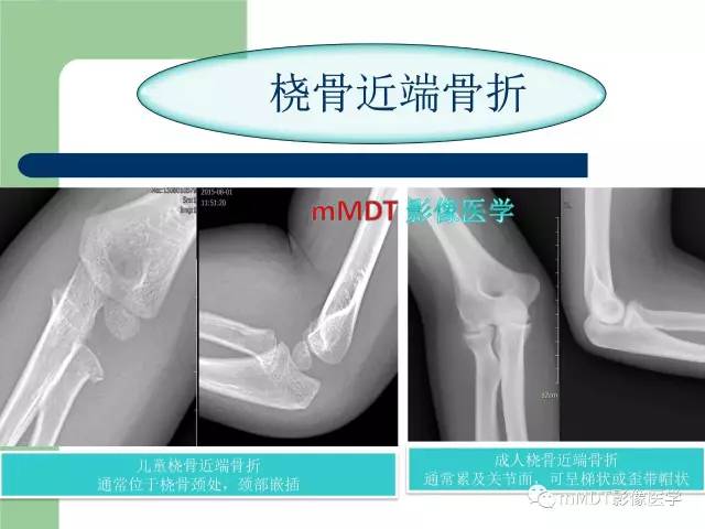 【PPT】儿童肘关节骨折的X线诊断