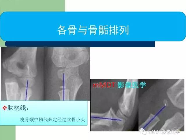 【PPT】儿童肘关节骨折的X线诊断