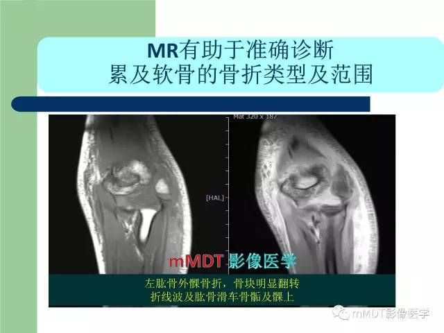 【PPT】儿童肘关节骨折的X线诊断
