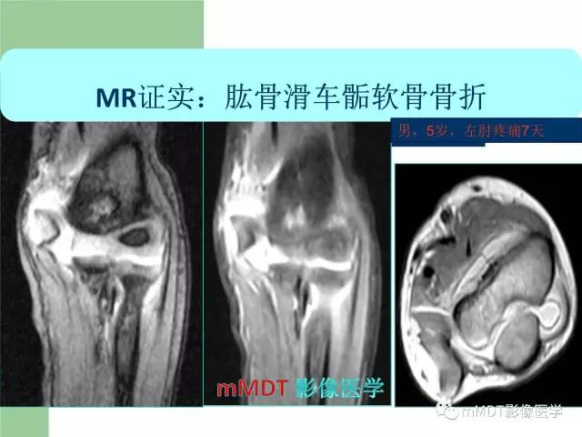 【PPT】儿童肘关节骨折的X线诊断