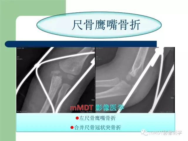 【PPT】儿童肘关节骨折的X线诊断
