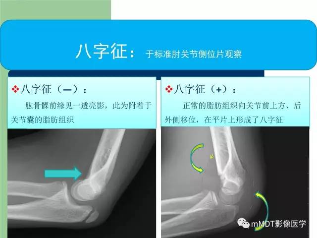 【PPT】儿童肘关节骨折的X线诊断