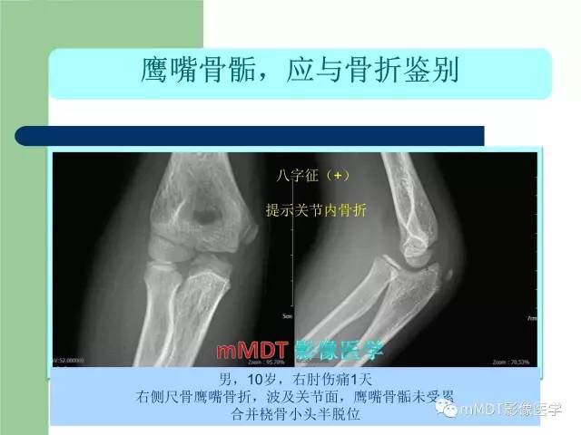 【PPT】儿童肘关节骨折的X线诊断