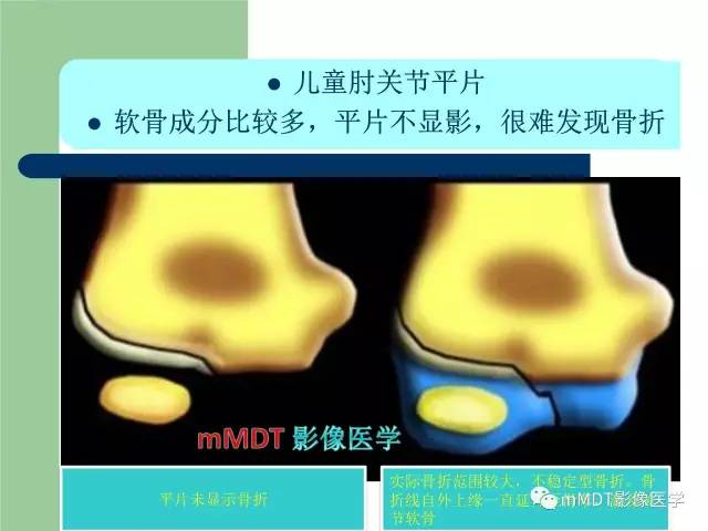 【PPT】儿童肘关节骨折的X线诊断