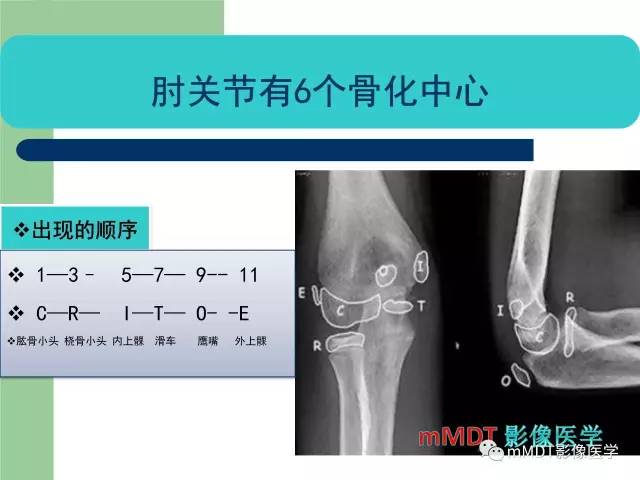 【PPT】儿童肘关节骨折的X线诊断