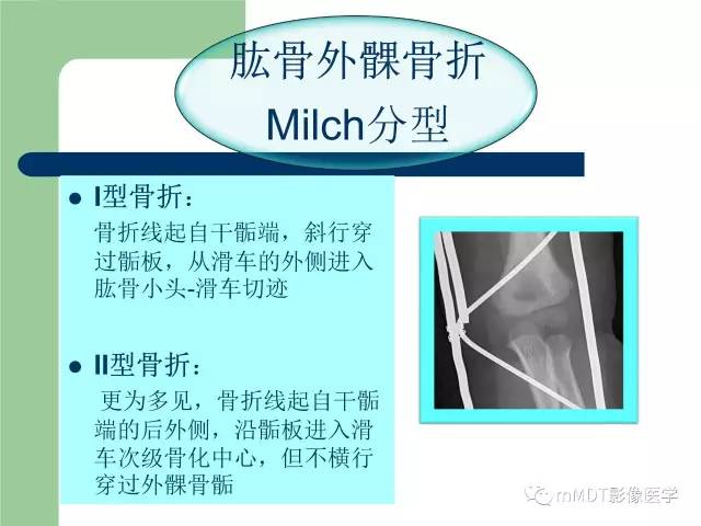 【PPT】儿童肘关节骨折的X线诊断