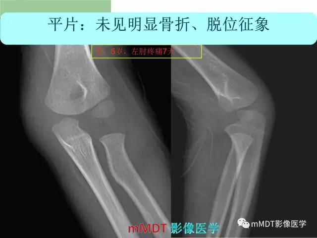 【PPT】儿童肘关节骨折的X线诊断