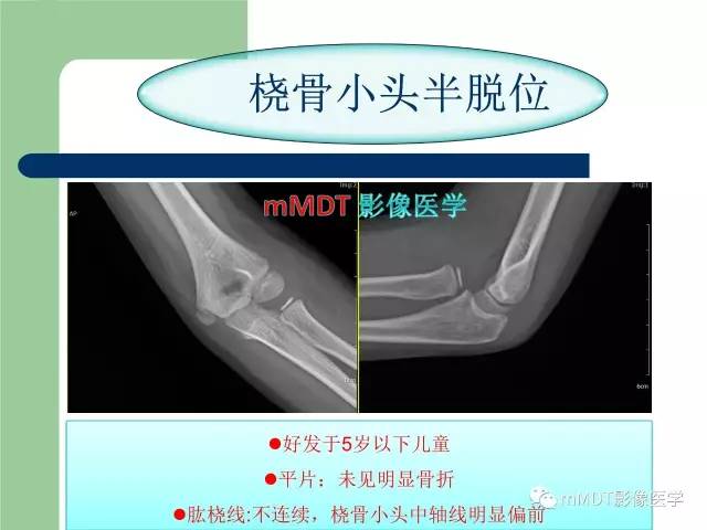 【PPT】儿童肘关节骨折的X线诊断