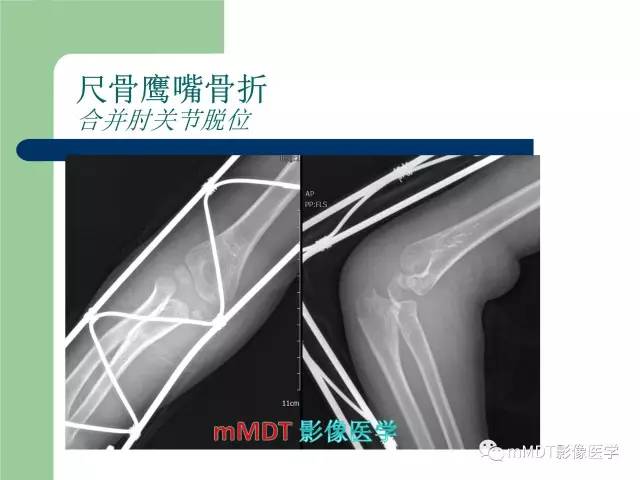 【PPT】儿童肘关节骨折的X线诊断
