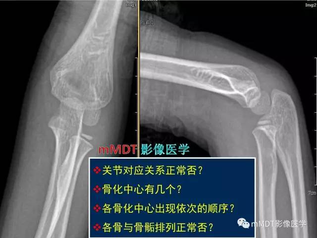 【PPT】儿童肘关节骨折的X线诊断