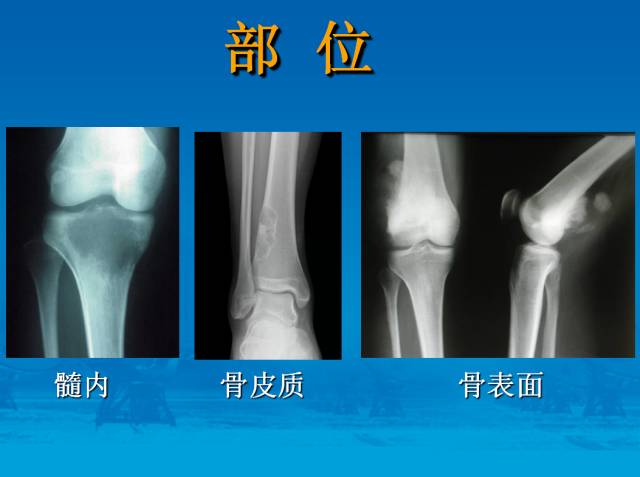 【PPT】骨肿瘤良恶性鉴别诊断