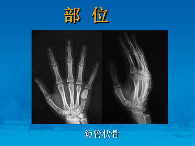 【PPT】骨肿瘤良恶性鉴别诊断