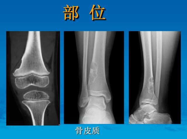 【PPT】骨肿瘤良恶性鉴别诊断