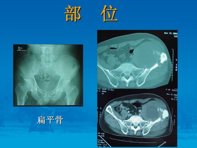 【PPT】骨肿瘤良恶性鉴别诊断