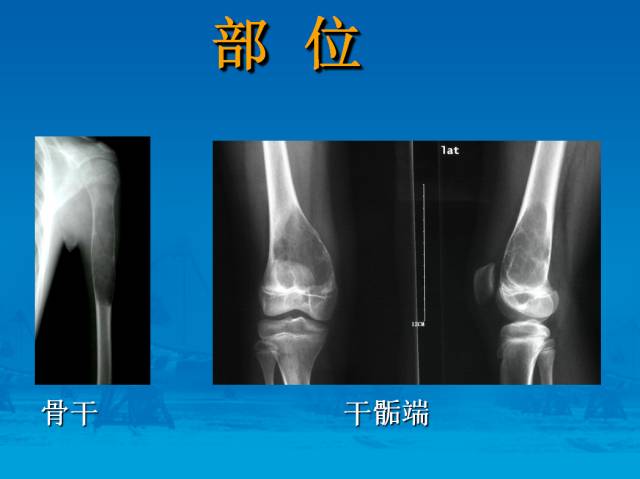【PPT】骨肿瘤良恶性鉴别诊断
