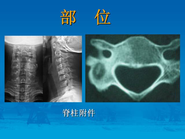 【PPT】骨肿瘤良恶性鉴别诊断