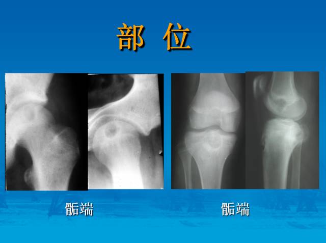 【PPT】骨肿瘤良恶性鉴别诊断