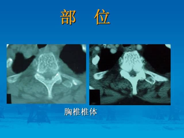 【PPT】骨肿瘤良恶性鉴别诊断