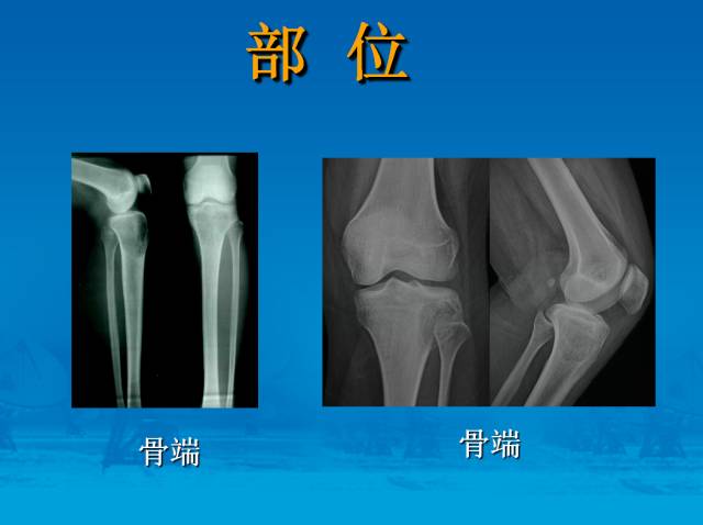 【PPT】骨肿瘤良恶性鉴别诊断
