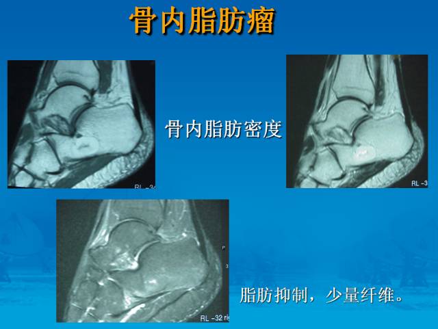 【PPT】骨肿瘤良恶性鉴别诊断