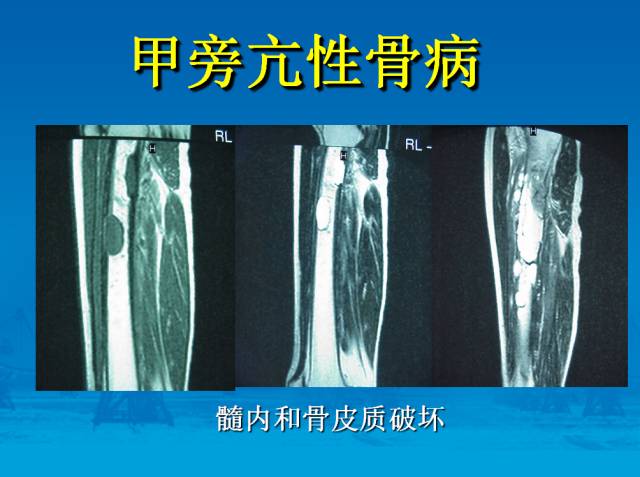 【PPT】骨肿瘤良恶性鉴别诊断