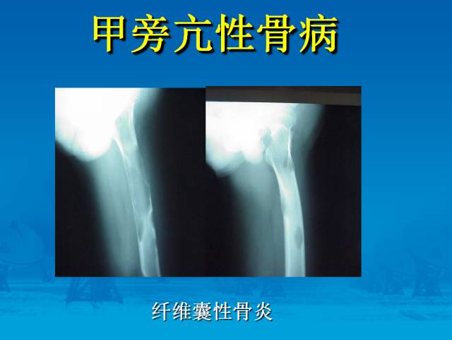 【PPT】骨肿瘤良恶性鉴别诊断