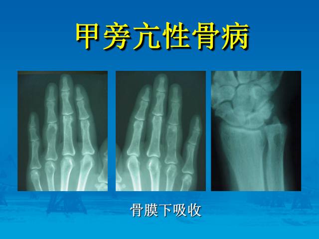 【PPT】骨肿瘤良恶性鉴别诊断