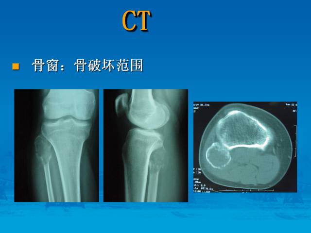 【PPT】骨肿瘤良恶性鉴别诊断