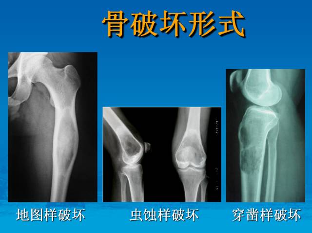 【PPT】骨肿瘤良恶性鉴别诊断