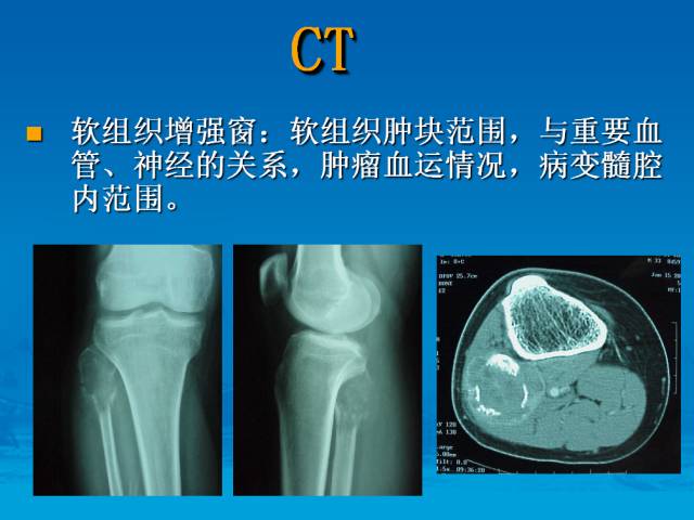 【PPT】骨肿瘤良恶性鉴别诊断