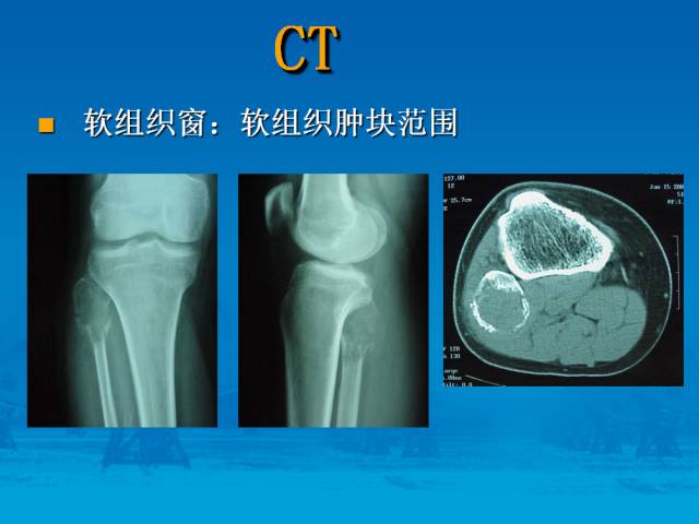 【PPT】骨肿瘤良恶性鉴别诊断