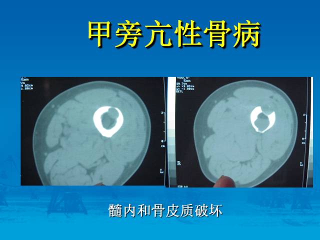 【PPT】骨肿瘤良恶性鉴别诊断