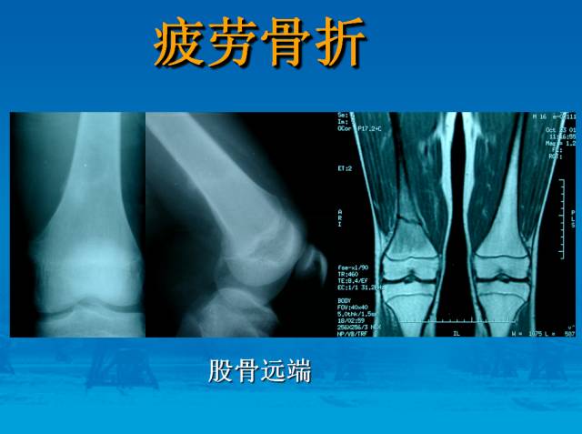 【PPT】骨肿瘤良恶性鉴别诊断