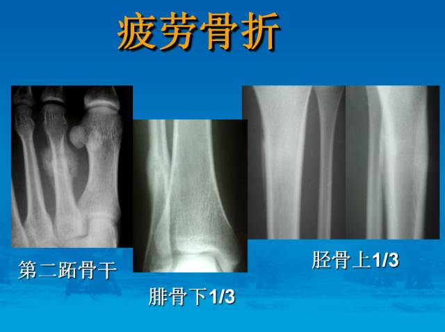 【PPT】骨肿瘤良恶性鉴别诊断