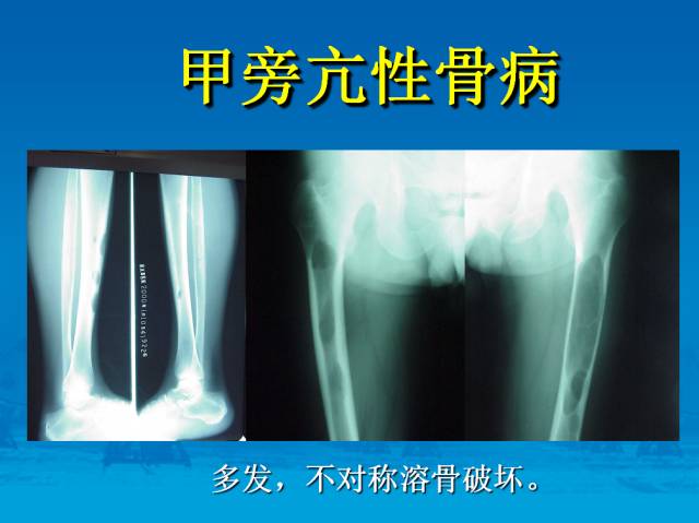 【PPT】骨肿瘤良恶性鉴别诊断