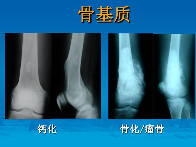 【PPT】骨肿瘤良恶性鉴别诊断