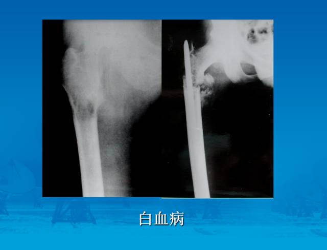 【PPT】骨肿瘤良恶性鉴别诊断