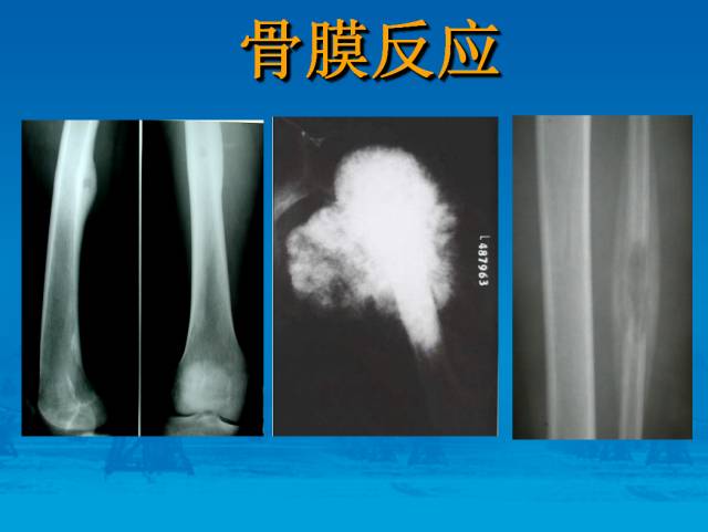 【PPT】骨肿瘤良恶性鉴别诊断