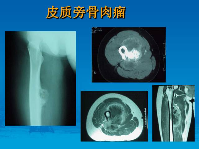 【PPT】骨肿瘤良恶性鉴别诊断