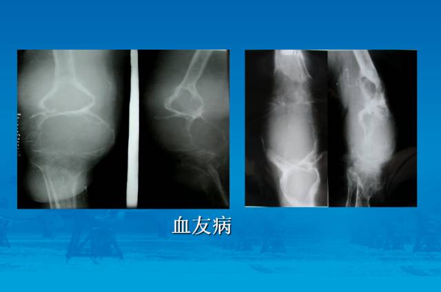 【PPT】骨肿瘤良恶性鉴别诊断