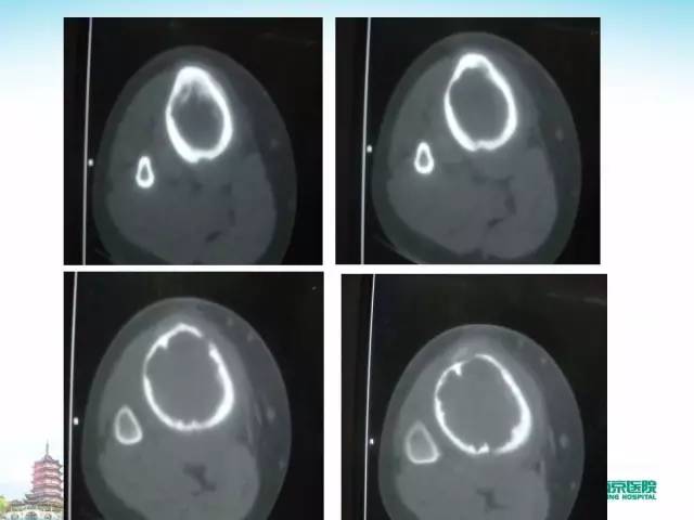【PPT】骨肉瘤的影像诊断