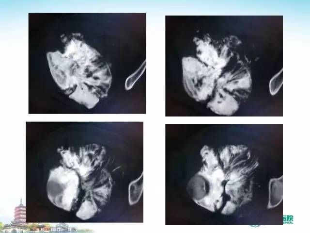 【PPT】骨肉瘤的影像诊断