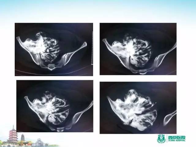 【PPT】骨肉瘤的影像诊断