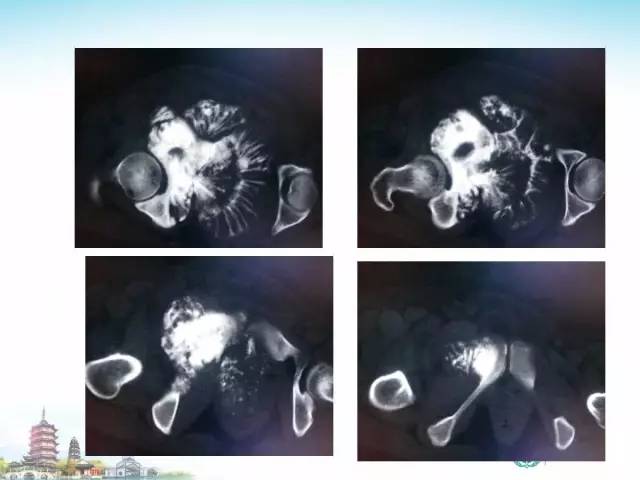 【PPT】骨肉瘤的影像诊断