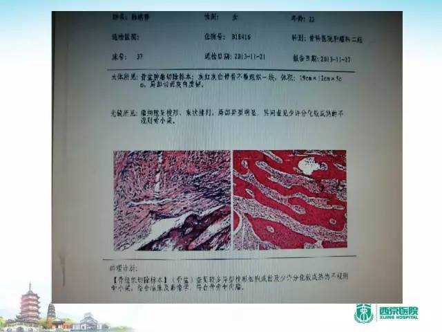 【PPT】骨肉瘤的影像诊断