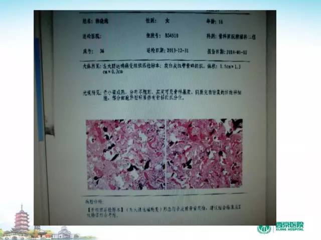 【PPT】骨肉瘤的影像诊断
