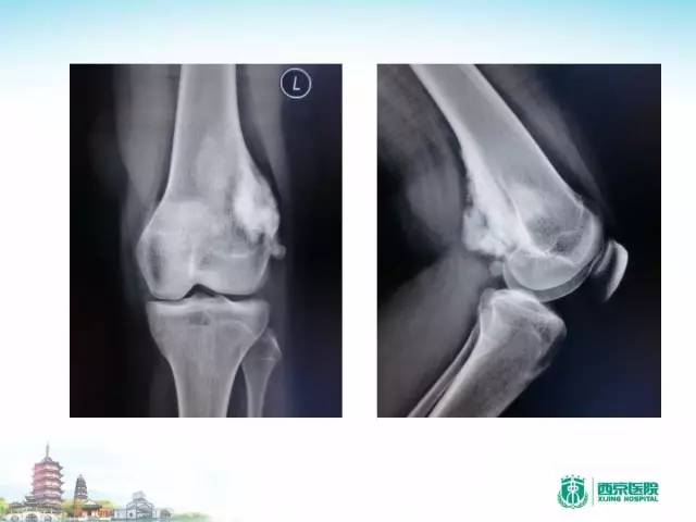 【PPT】骨肉瘤的影像诊断